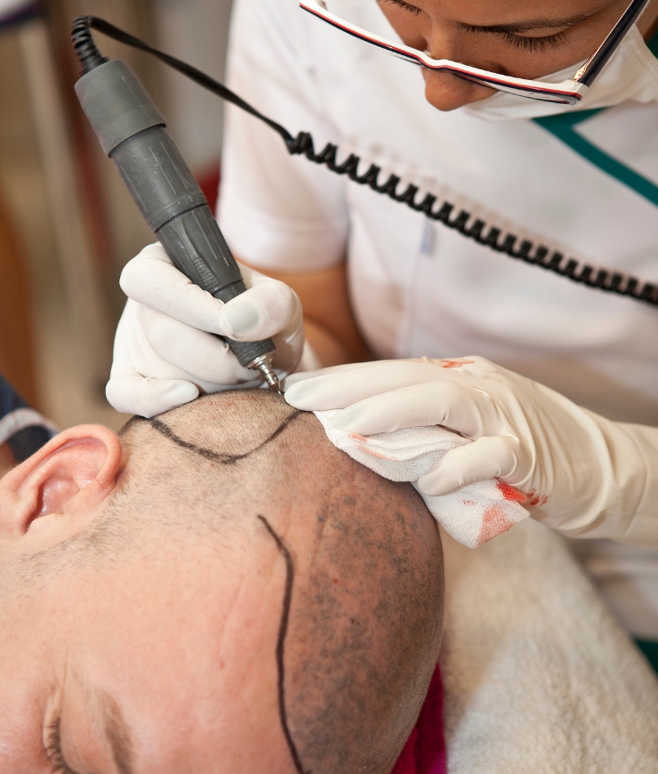 Hair Transplant (FUE FUT)