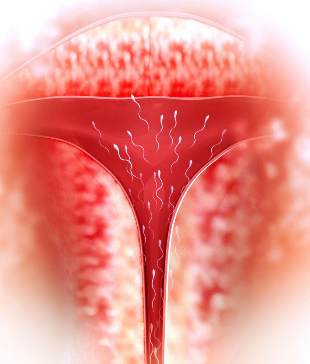 IUI (Intrauterine Insemination)